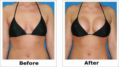 Bestina breast enlargement capsules smackdeal